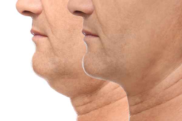 HIFU - Breakthrough in Anti - ageing 2 hifu results Harlow