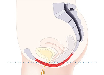 Pelvic-Floor Muscle Repair 5 Pelvic floor muscles Harlow