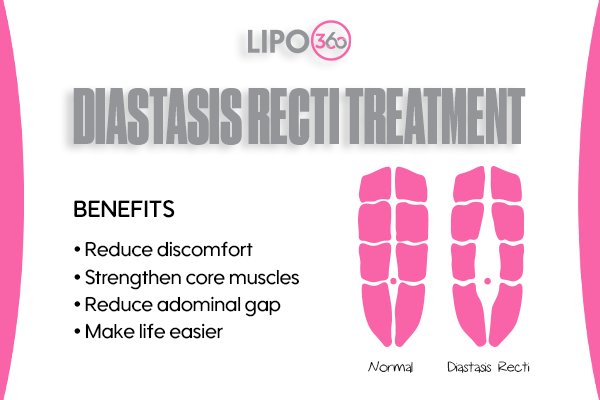 Revolutionising Muscle Repair: The Power of LIPO360 Body Sculpt Post-Injury 5 diastasis recti treatment Harlow