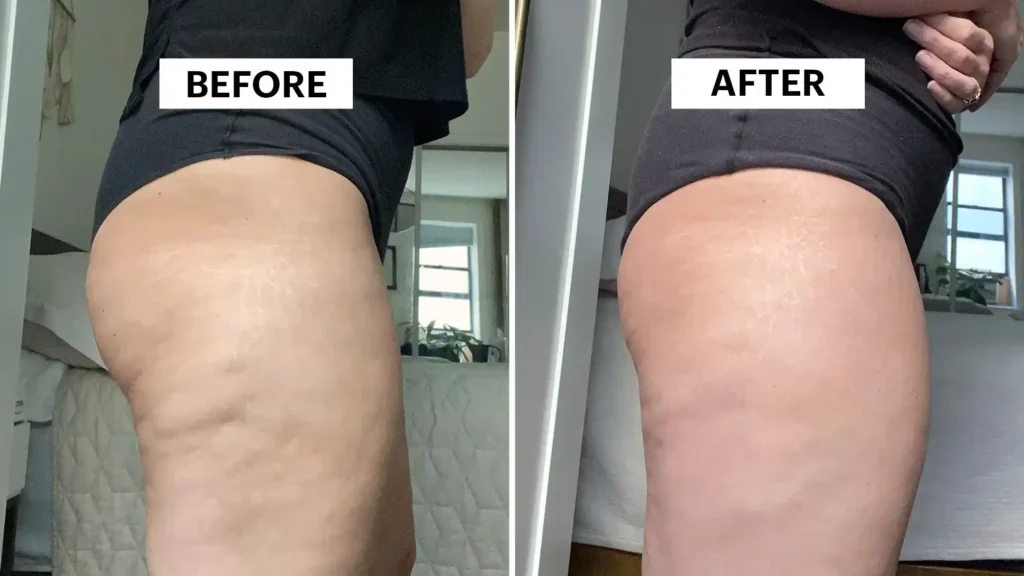 Sculpting Your Bum: Can Toning Exercises Really Reduce Cellulite? 1 Do Toning Exercise Harlow Really Tackle Cellulite?