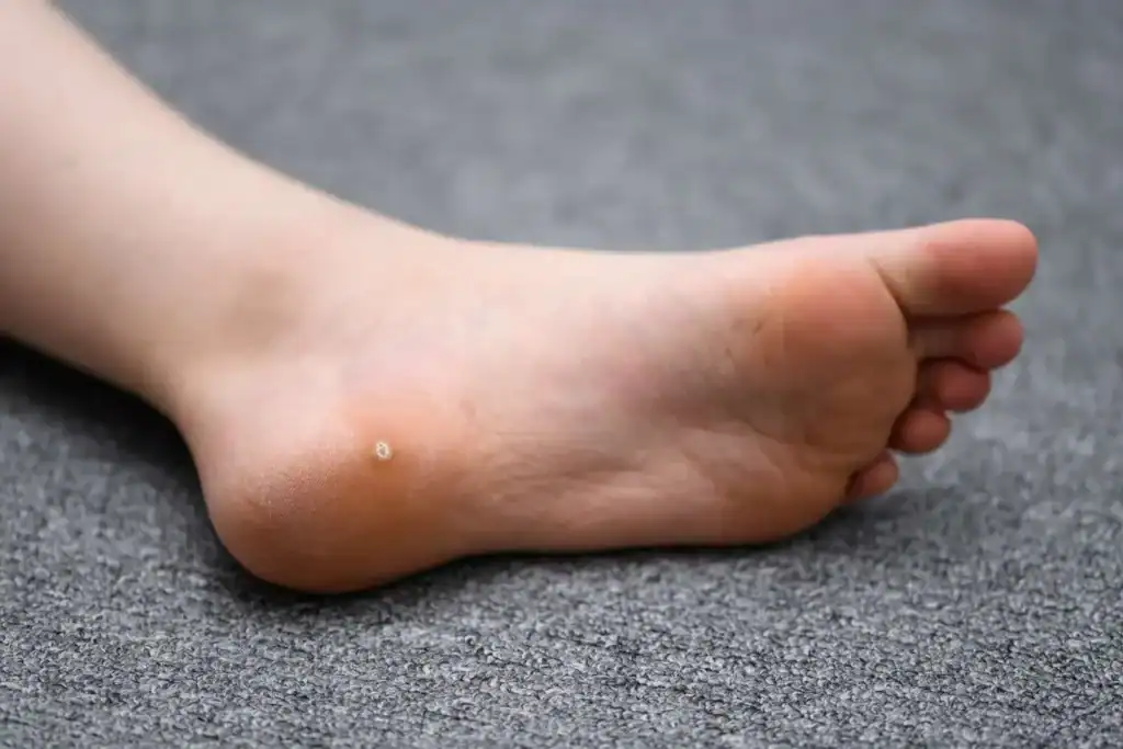 Cryotherapy For Warts And Also Verrucas 2 Image of verruca on the bottom of the foot that able to be treated with Cryotherapy Harlow