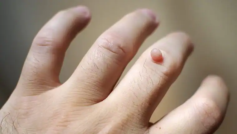 Cryotherapy For Warts And Also Verrucas 1 Image of blemish that Cryotherapy Harlow can remove with Lipo 360.