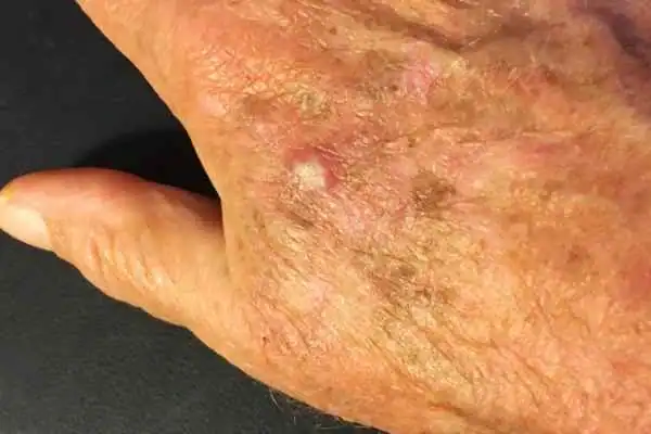 Image of Actinic keratoses Harlow on a person hand