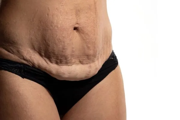 The science behind skin tightening Harlow picture of a woman's sagging skin on the stomach
